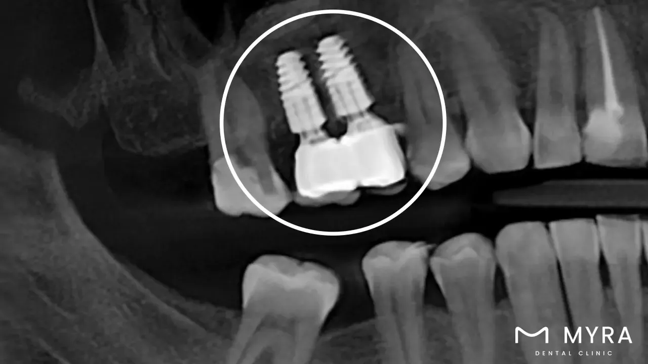 2. Multiple Tooth Implant.webp
